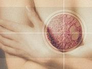cancerul de san, cancer la san, noduli la san, sani sanatosi, mamografii, mamografie, controlul periodic al sanilor, cum se trateaza cancerul, tumori, tumoare canceroasa la sani