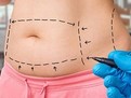 abdominplastie abdominoplastie_abdominoplastia_chirurgie_estetica_liposuctie_ce_este_abdominoplastia_preturi_abdominoplastie_400