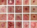cancerul de piele, simptome cancer piele, melanom, cum se manifesta cancerul de piele, ce este cancerul de piele, cum se depisteaza cancerul de piele, cum se trateaza cancerul de piele, cum ne ferim de cancerul de piele