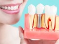implant dentar implant dentar, cum se face implantul dentar, cat costa un implant dentar, avantaje implant dentar