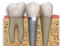 Implanturile dentare, despre Implanturile dentare, ce sint Implanturile dentare, cit dureaza sa pui Implanturi dentare, cat costa Implanturile dentare