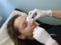 peeling chimic metoda chimica de peeling peeling chimic metoda chimica de peeling