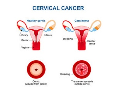 Cancerul de col uterin: cauze, simptome, tratament