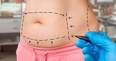 abdominoplastie_abdominoplastia_chirurgie_estetica_liposuctie_ce_este_abdominoplastia_preturi_abdominoplastie_400