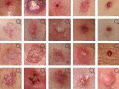 cancerul de piele, simptome cancer piele, melanom, cum se manifesta cancerul de piele, ce este cancerul de piele, cum se depisteaza cancerul de piele, cum se trateaza cancerul de piele, cum ne ferim de cancerul de piele
