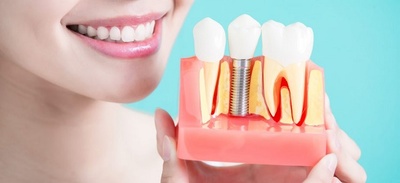 implant dentar, cum se face implantul dentar, cat costa un implant dentar, avantaje implant dentar