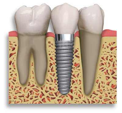 Implanturile dentare, despre Implanturile dentare, ce sint Implanturile dentare, cit dureaza sa pui Implanturi dentare, cat costa Implanturile dentare