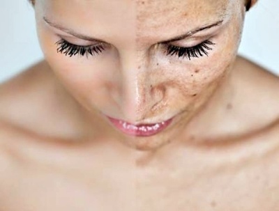 simptome melasma, cloasma, colasma, simptomele melasmei, cum se manifesta melasma, ce este cloasma, masca gravidiei