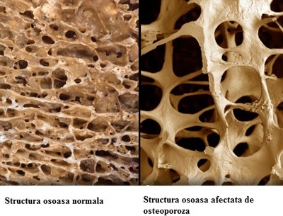 osteoporoza, osteoporoza, ce este osteoporoza, cum tratam osteoporoza,  boli ale oaselor