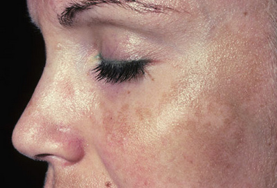 melasma, cloasma, colasma, femei insarcinate, pete pe fata, de ce apare melasma, tratament melasma, tratamente cloasma, simptome melasma, simptome cloasma, simptome colasma