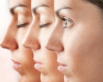 ingrijirea tenului cu melasma, cum sa maschezi cloasma, metode ingrijire, melasma, colasma, ce este cloasma, creme depigmentare ingrijirea tenului cu melasma, cum sa maschezi cloasma, metode ingrijire ten gravida, melasma, colasma